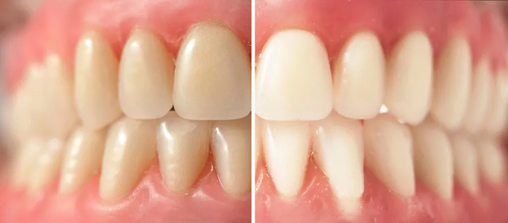 teeth-whitening1