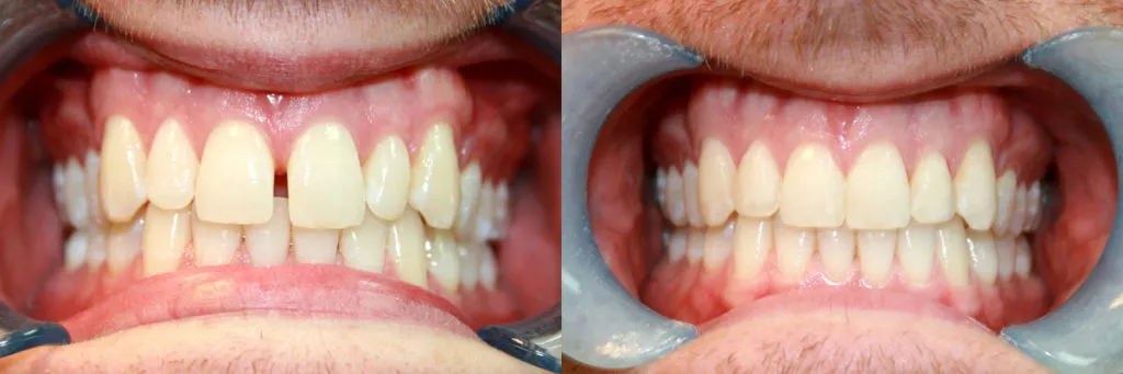 Diastema closure with fixed brace
