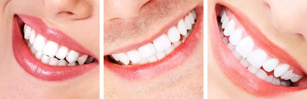 teeth-whitening3